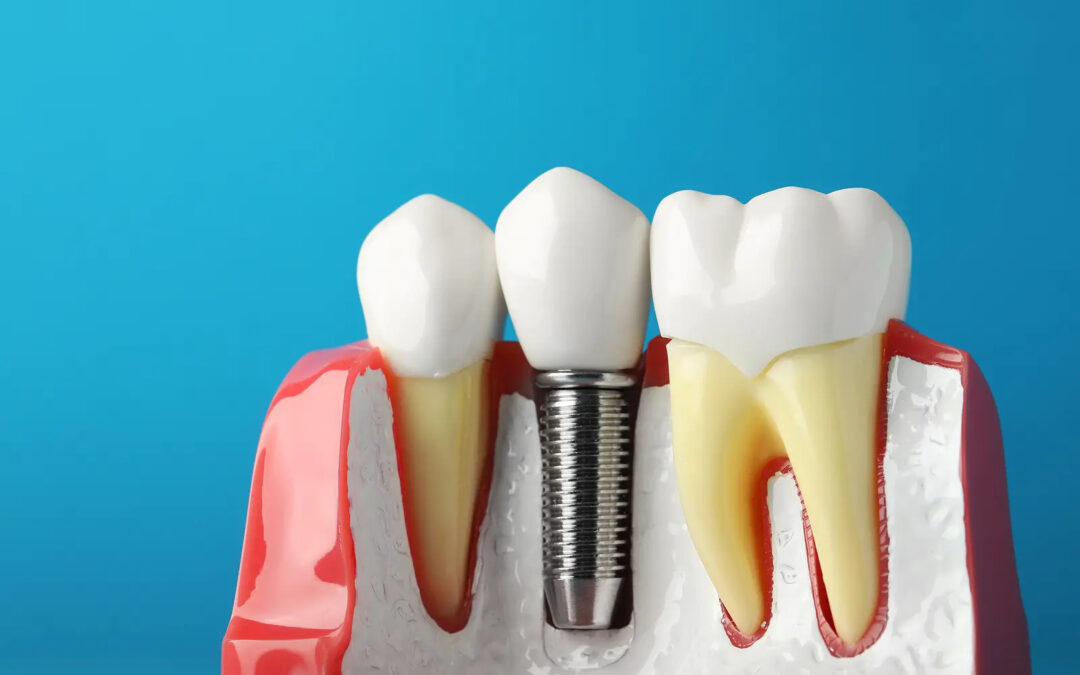 Dental Implants: Will They Deteriorate Faster Than Expected?