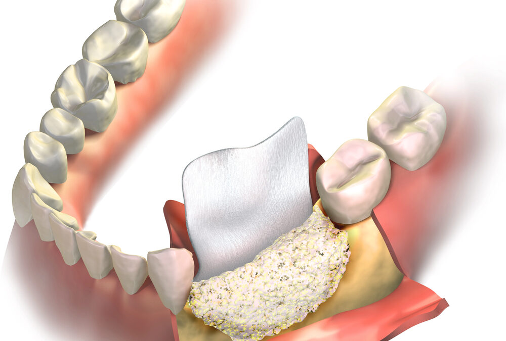 Bone Augmentation: Giving Your Jaw More Foundational Strength